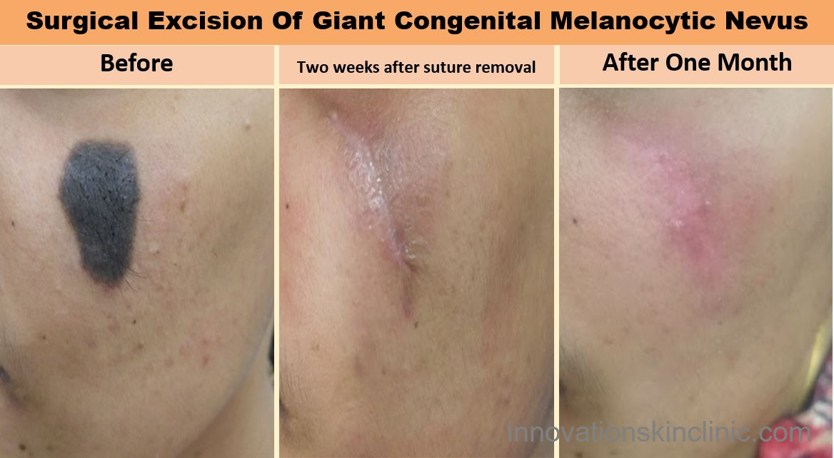 Surgeries For Benign Skin - Congenital Melanocytic Nevus